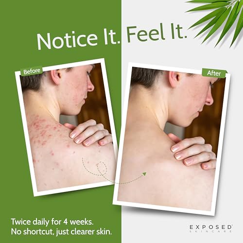 Body Acne Wash with 0.5% Salicylic Acid for Clearer Skin - Gentle, Paraben-Free