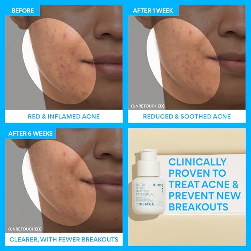 Gentle Retinol Serum with Salicylic Acid for Acne & Clear Skin - Korean Face Treatment