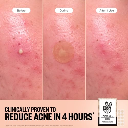 PEACE OUT Acne Healing Dots Hydrocolloid Pimple Patches, Acne Spot Patches with Salicylic Acid, Retinol, and Aloe Vera for Blemishes and Breakouts, 60 Count