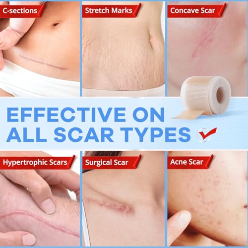 Wifamy Silicone Scar Sheets for Women: Medical Grade Scar Removal C-Section Recovery & Post-Surgery Care (1.6"X 120" Roll-3M)