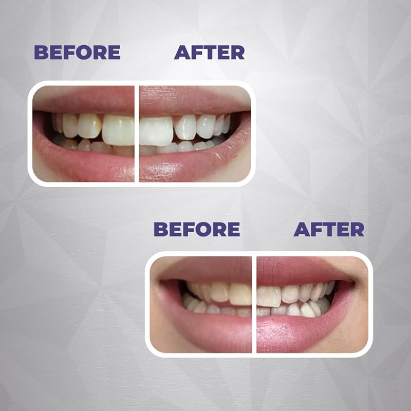 Gentle Whitening & Remineralization Teeth Strips - Peroxide-Free, Enzyme & Hydroxyapatite Formula, 14 Treatments