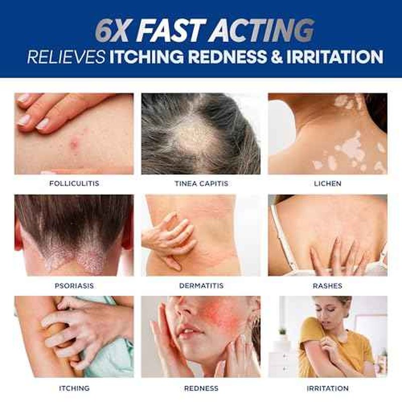 Folliculitis Treatment Cream: Effective Treatment for Folliculitis Scalp Face and Body 100g