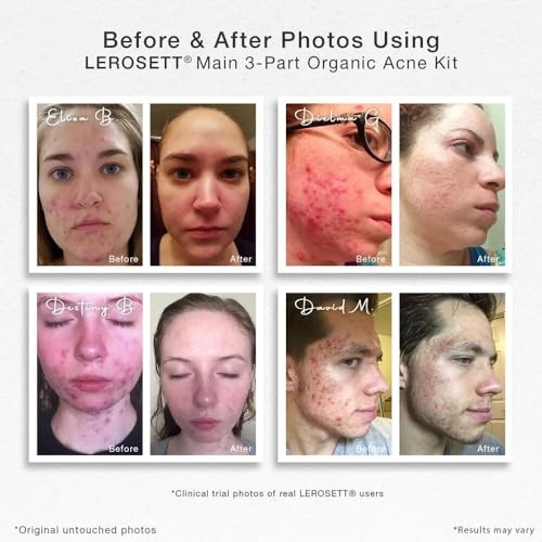LEROSETT Acne Kit Includes Cleanser Moisturizer & Spot Treatment Mask Organic Calming Aloe & Clay Based, Clears Acne, Pimples, Blackheads & Breakouts, Vegan Acne Kit, For All Skin Types