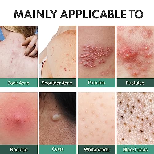 Back Acne Spray with Salicylic Acid & Tea Tree Oil - Body Acne Treatment, 4 oz