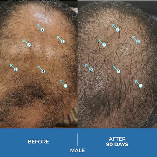 DS Labs Spectral.UHP 5% Minoxidil Hair Serum for Thinning Hair, 3 Pack - Supports Thicker, Fuller Hair at Crown