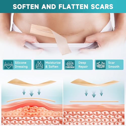 Silicone Scar Sheets 10 Pcs - Soft Medical Tape for Surgical & Keloid Scars, 5.7 x 1.57 Inches