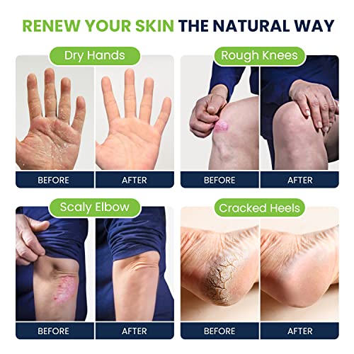 Tea Tree Oil Foot Cream - Moisturizing Athletes Foot Care For Dry Cracked Feet Cream - Heel & Callus Removal,& Tea Tree Foot Soak, Callus Remover Gel Foot File Pedicure Kit
