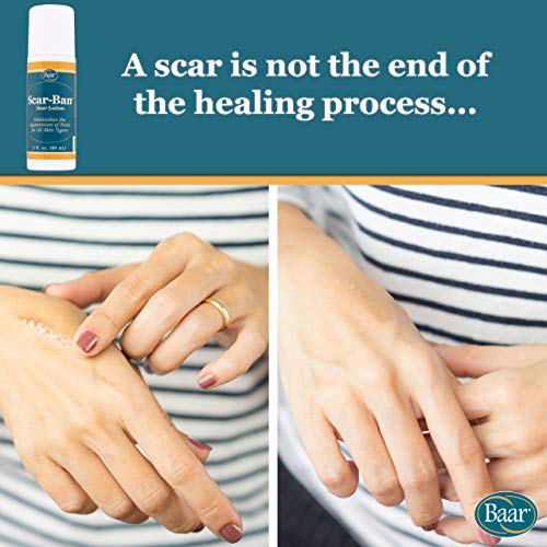Scar Ban Roll On, 3 oz.