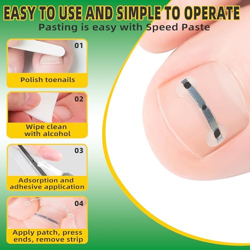Ingrown Toenail Treatment Kit, Titanium Alloy Ingrown Toenail Removal Kit, Nails Corrector Tool & Remover Strips - Ingrown Toe Nail Quick Relief