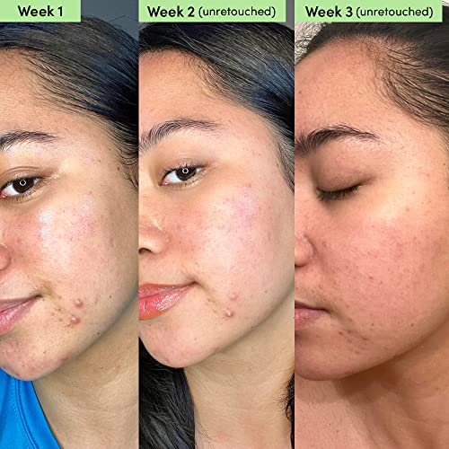 Sand & Sky Oil Control Clay Face Mask with Salicylic Acid & Niacinamide for Blemish-Prone Skin