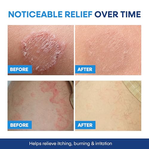 Hermon Jock Itch Treatment Soap - 4 Bars for Fungal Skin Relief