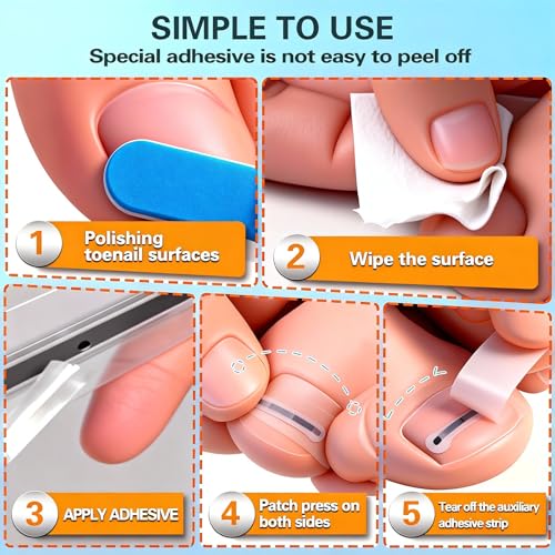 Titanium Alloy Ingrown Toenail Treatment - Professional Home Care for Curved Nails - Waterproof, Nail Tools and Ingrown Toenail Removal Kit,Ingrown Toenail Corrector(0.59/0.67in)