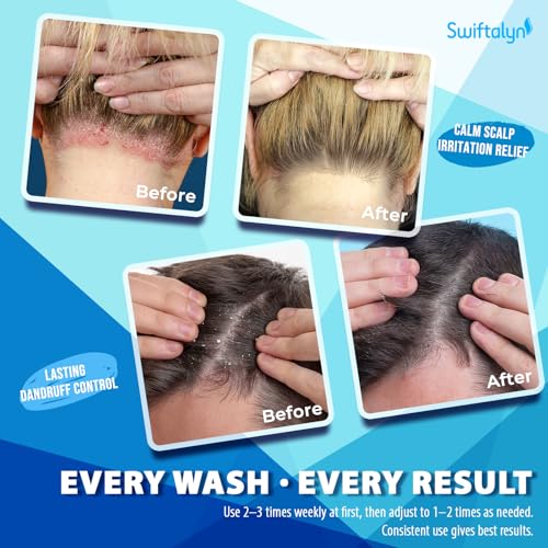 Swiftalyn Herbal Fresh Antifungal Shampoo for Seborrheic Dermatitis & Dandruff – Soothes Itchy Scalp