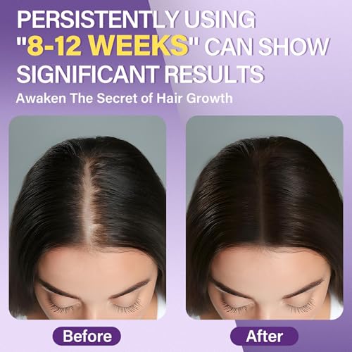 Women’s 5% Minoxidil Hair Growth Foam for Thinning Hair - Nourishing Scalp Treatment