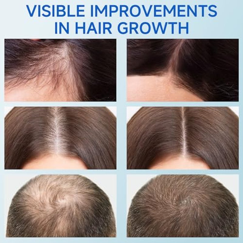 Hair Growth Serum Roll On, Rosemary Oil for Hair Growth, Be Roll On Rosemary Plant Essential Oils Extract Helps Support Body Thicker Fuller Hair for Men Women Wise Pick