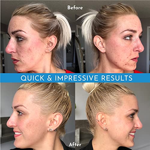 Truly Clear Plant-Based Acne Treatment Bar with Salicylic Acid & Hyaluronic Acid - Variation 1