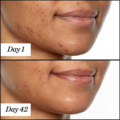 Sunday Riley U.F.O. Acne Face Oil 0.5 Fl Oz - Salicylic & Tea Tree Treatment