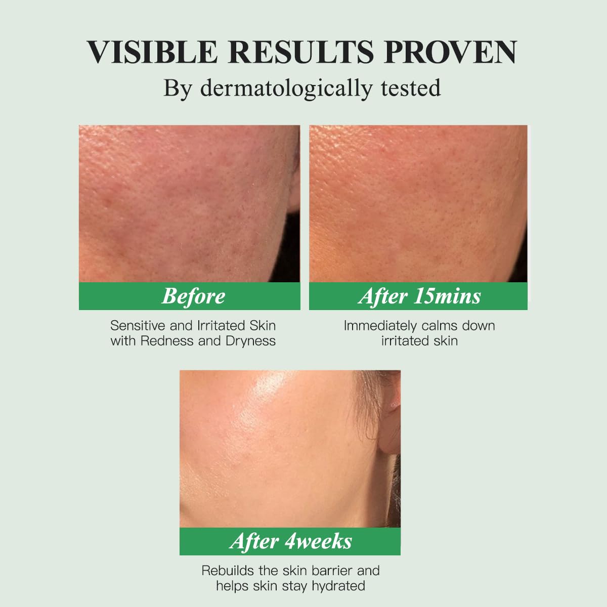 HKH Madagascar Centella Ampoule Serum - Soothing Acne Prone, Sensitive Skin Relief, Calming, Barrier Repair & Intense Hydration, 5X Centella Asiatica (Cica), 5X Ceramides, 8X Hyaluronic Acid, 30ml