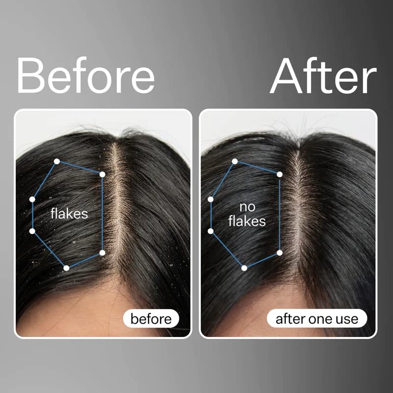 ACT+ ACRE Scalp Detox & Exfoliating Oil Bundle for Dry Itchy Scalp