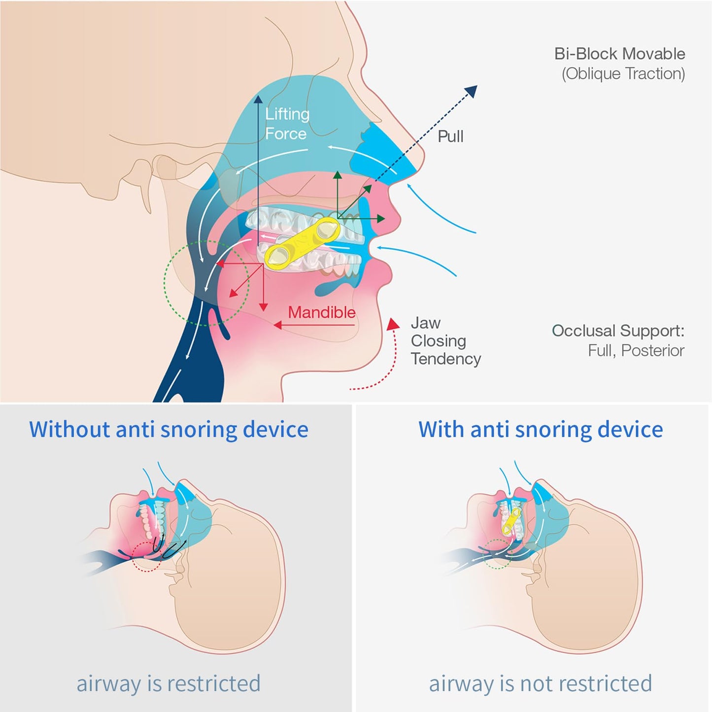 20PCS Replacement Elastic Straps for Meyson EMA Application (Blue, 19 mm)