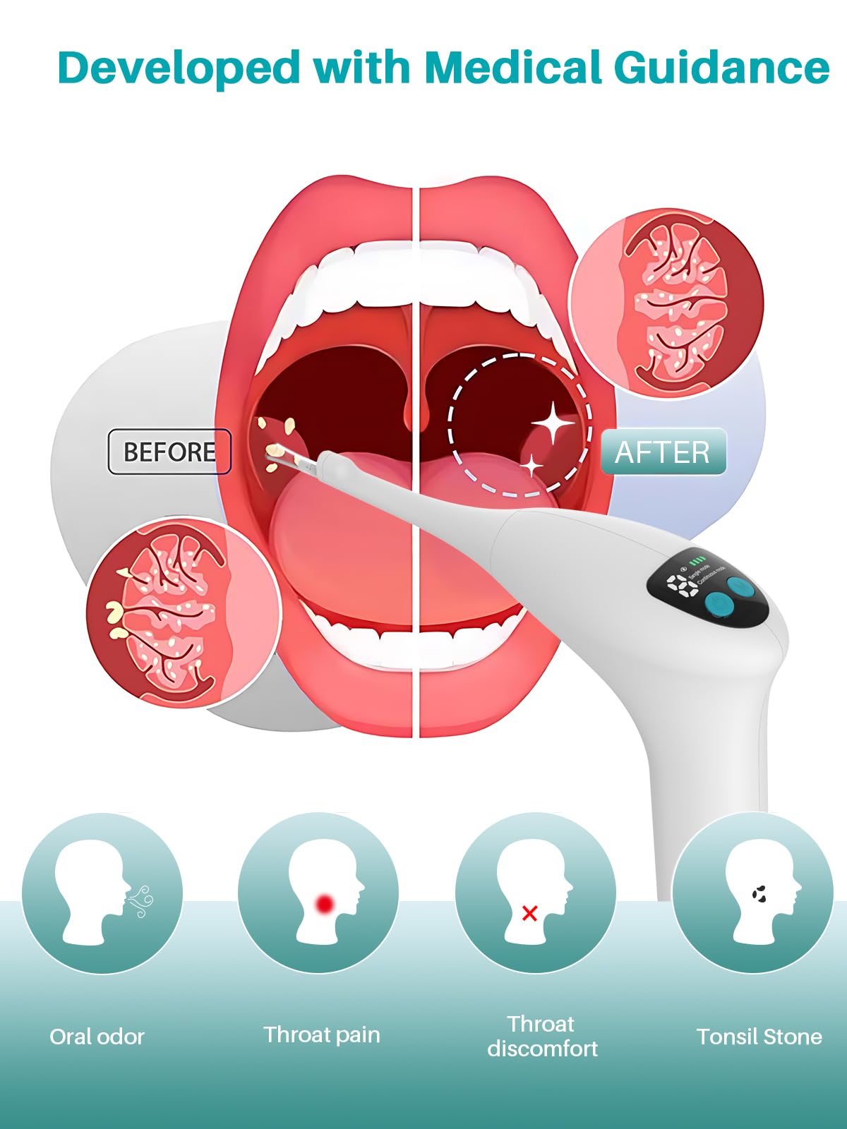 Voraiya Electronic Tonsil Stone Remover Upgraded Version, Built-in Camera and LED Light, 5-Level Suction and 2 Suction Modes Tonsil Stone Vacuum Cleaner, Oral Care Tool, Tonsil Stone Removal Kit