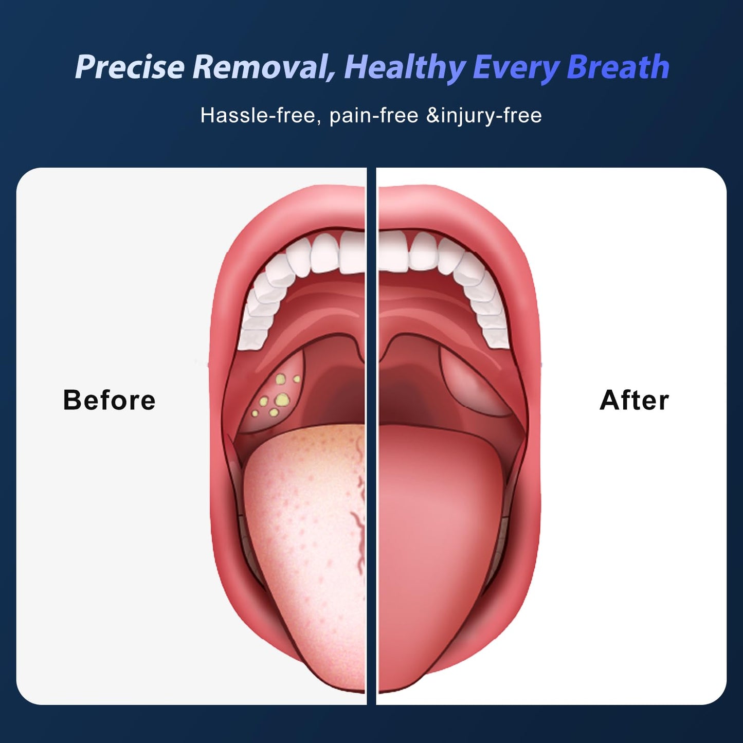 Upgraded Tonsil Stone Remover Tool with Silicone & Glass Probes, 11 in 1 Rechargeable Electronic Tonsil Stone Vacuum with Built-in LED Light, Fight Bad Breath Instant Suction