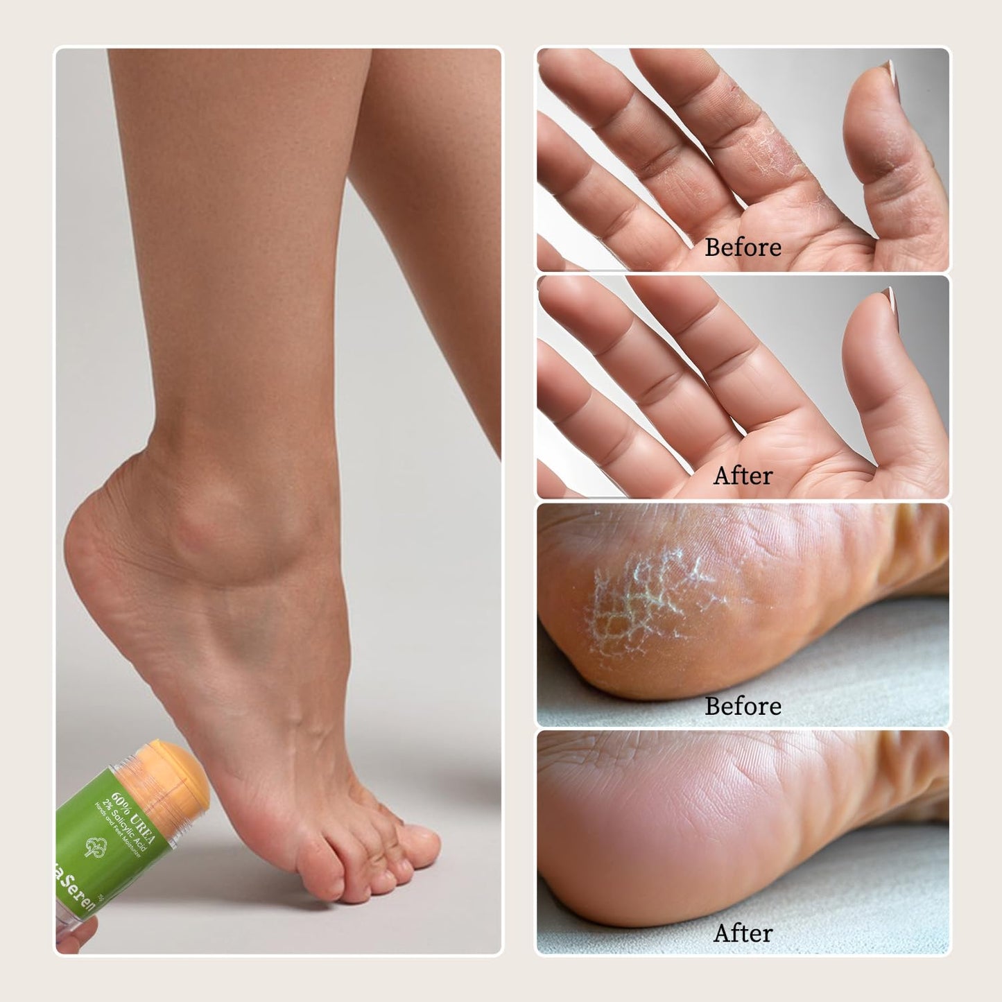 60% Urea Cream 2.65 Ounce Heel Balm Stick Cracked Heel Repair Balm Stick for Dry Cracked Feet Treatment with Aloe Vera, Jojoba Oil, Shea Butter & Tea Tree Oil for Dry Cracked Heels