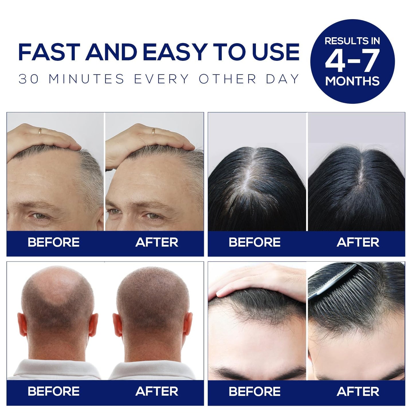 Laser Hair Growth Cap, Red Light Therapy Cap, Laser Hair Growth System Hair Loss Treatments for Men and Women Hair Regrowth Treatments Laser Cap (White).