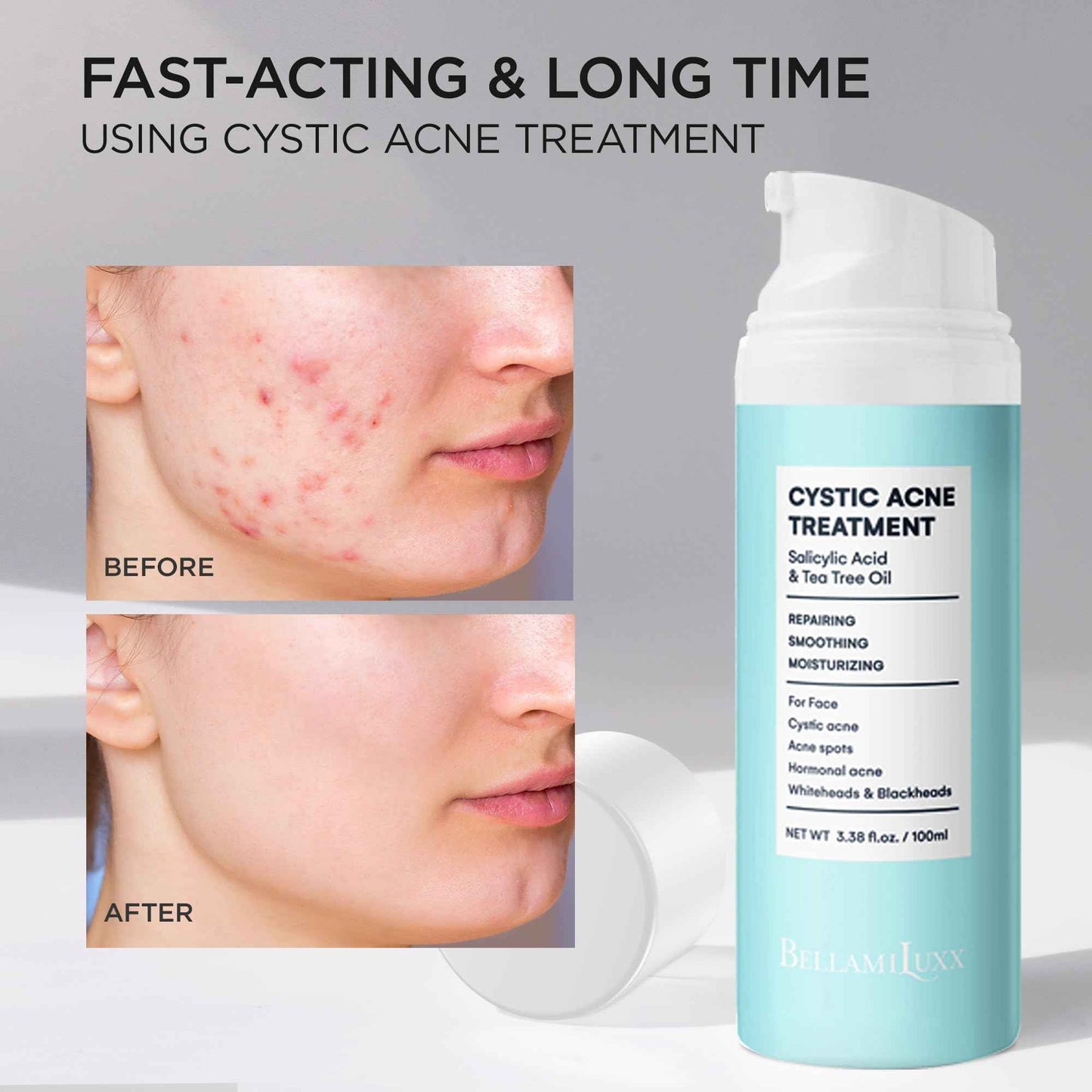 Acne Treatment for Face: Cystic Acne Spot Control Cream with Salicylic Acid & Tea Tree Oil for Blemishes - Gentle Hormonal & Pimple Treatment for Teens & Adults - 120 Day Supply & 3.38oz