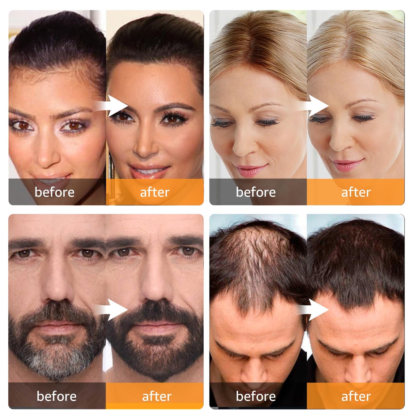 Abomet Root Touch Up Instantly Gray Hair Coverage Hairline Powder for Women & Men, Medium Brown for Concealing Hair Loss & Thinning Hair