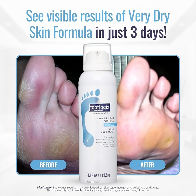 Footlogix Very Dry Skin Mousse for Feet – Urea, Co-Q10, Aloe & Vitamin E 4.23 fl oz