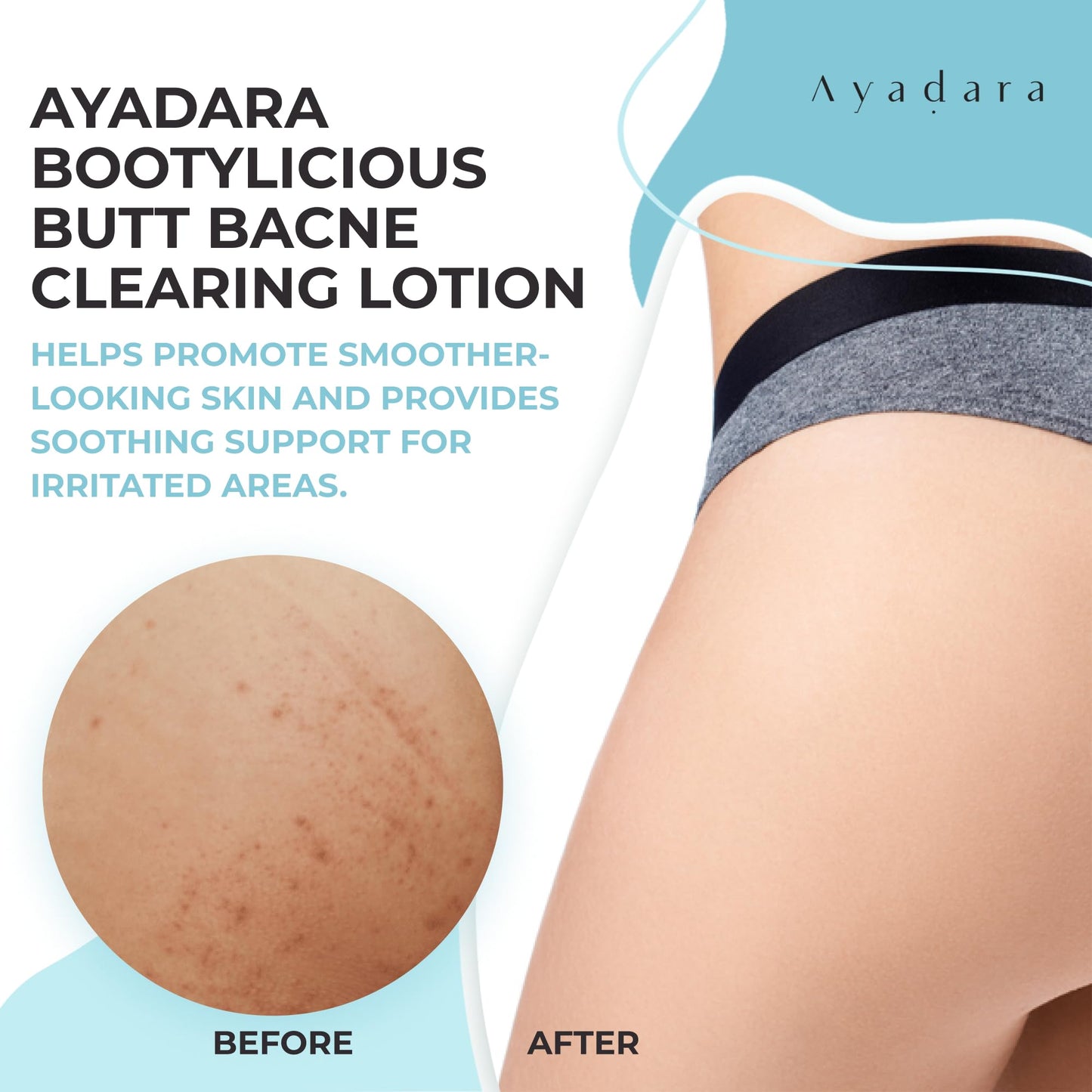 Ayadara Butt Acne Clearing Lotion, 8oz Butt Acne Cream with Salicylic Acid, Smoothing Butt Cream for Acne, Butt Acne Clearing Lotion for Women, Men, Teens, Chest and Back Acne Treatment, 90-Day Supply