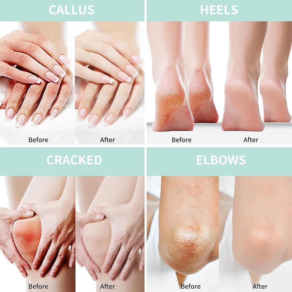 Urea Cream 40 Percent For Feet Plus 2% Salicylic Acid 5.29 oz || Foot Cream and Hand Cream Maximum Strength with Hyaluronic Acid,Tea Tree,and Aloe Vera For Deep Moisturizes,Callus Remover