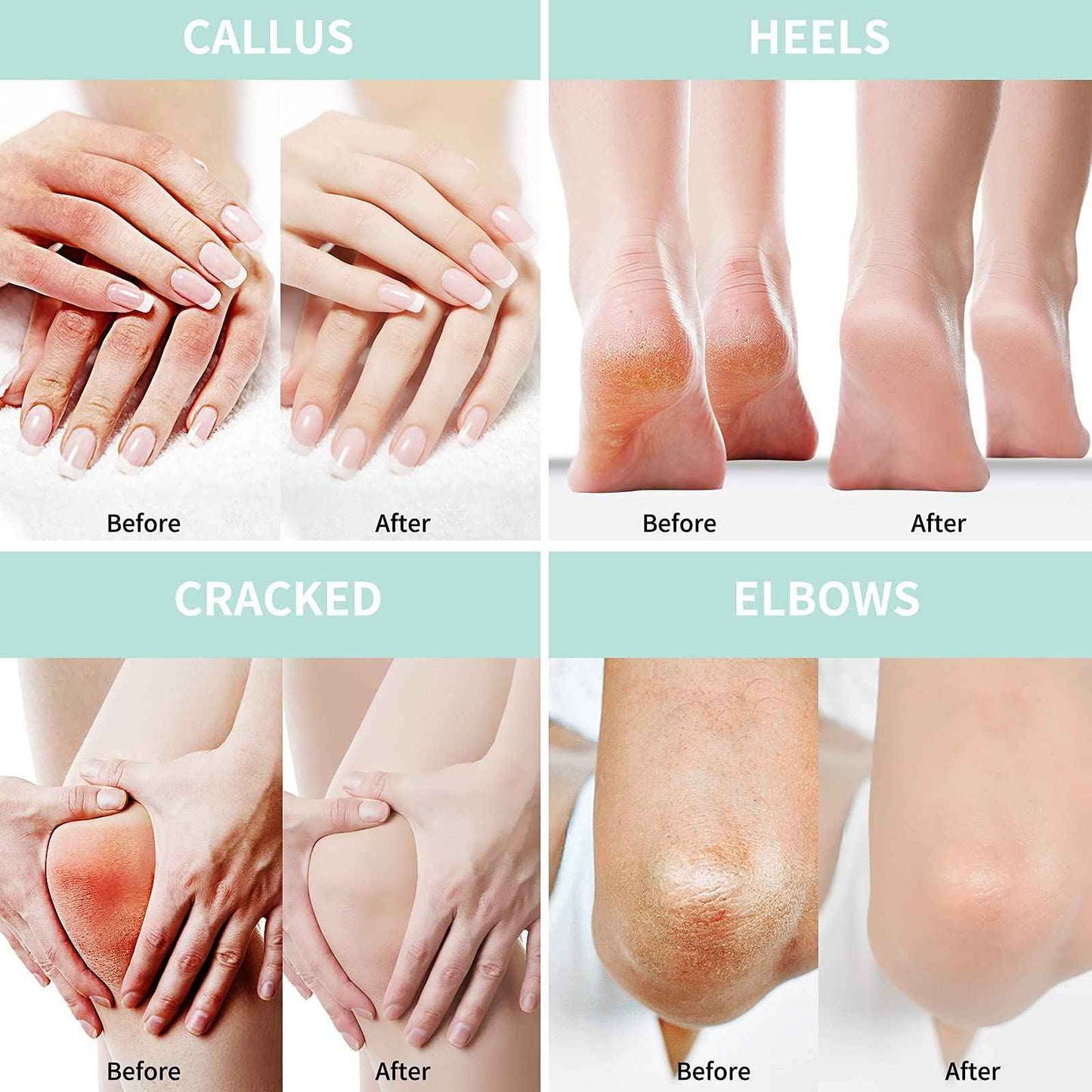 Grocerism 2 Packs Urea Cream 40% Plus 2% Salicylic Acid 5.30 oz || Foot Cream Maximum Strength with Hyaluronic Acid, Tea Tree, and Aloe Vera for Deep Moisturizes, Callus Remover and Soften