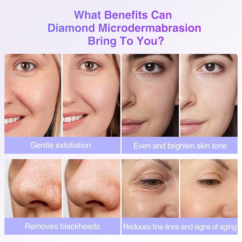Diamond Microdermabrasion Replacement Tips Kit – 9 Diamond Tips, 3 Wands, 50 Cotton Filters (US) – Variation: 9 Tips & 250 Filters