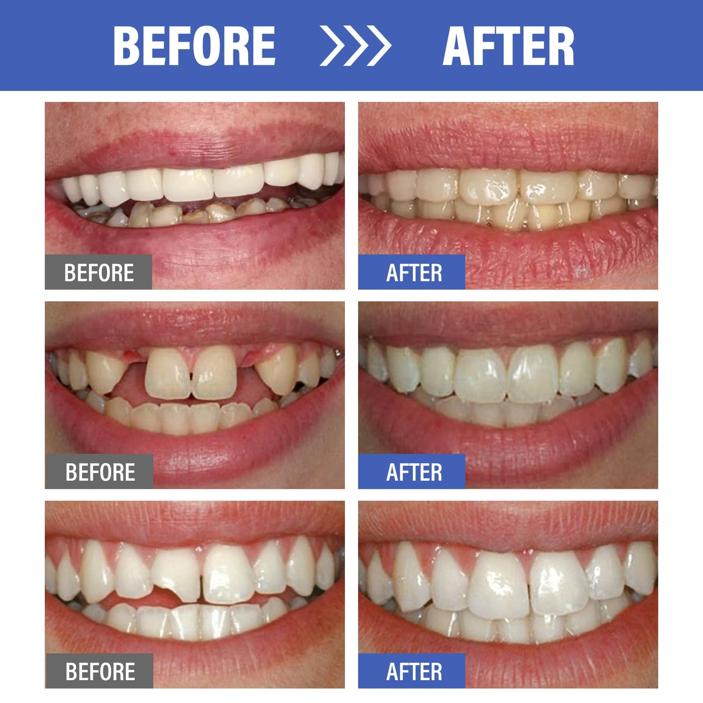 Tooth Repair Kit, Safe and Effective Fake Teeth Replacement, for Fixing Missing & Broken Teeth Replacement, Smile Confidently with 30ml Tooth Beads + 4 Dental Tools