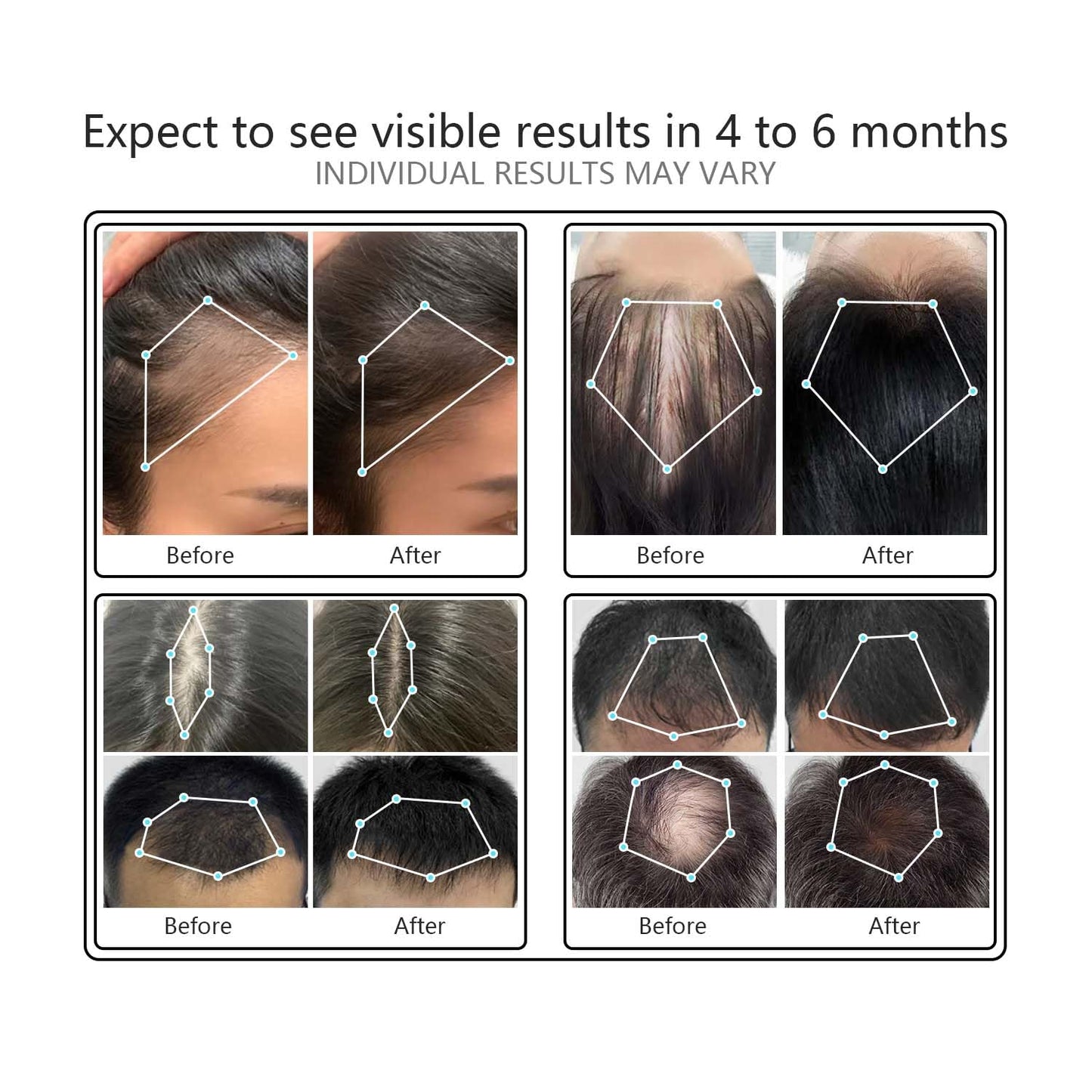 NBWTYA Laser Comb, Red Light Therapy for Hair Growth, Medical Grade Hair Loss Treatment Regrows Fuller and Thickness, Reverses Thinning, Stimulates Growth for Men & Women