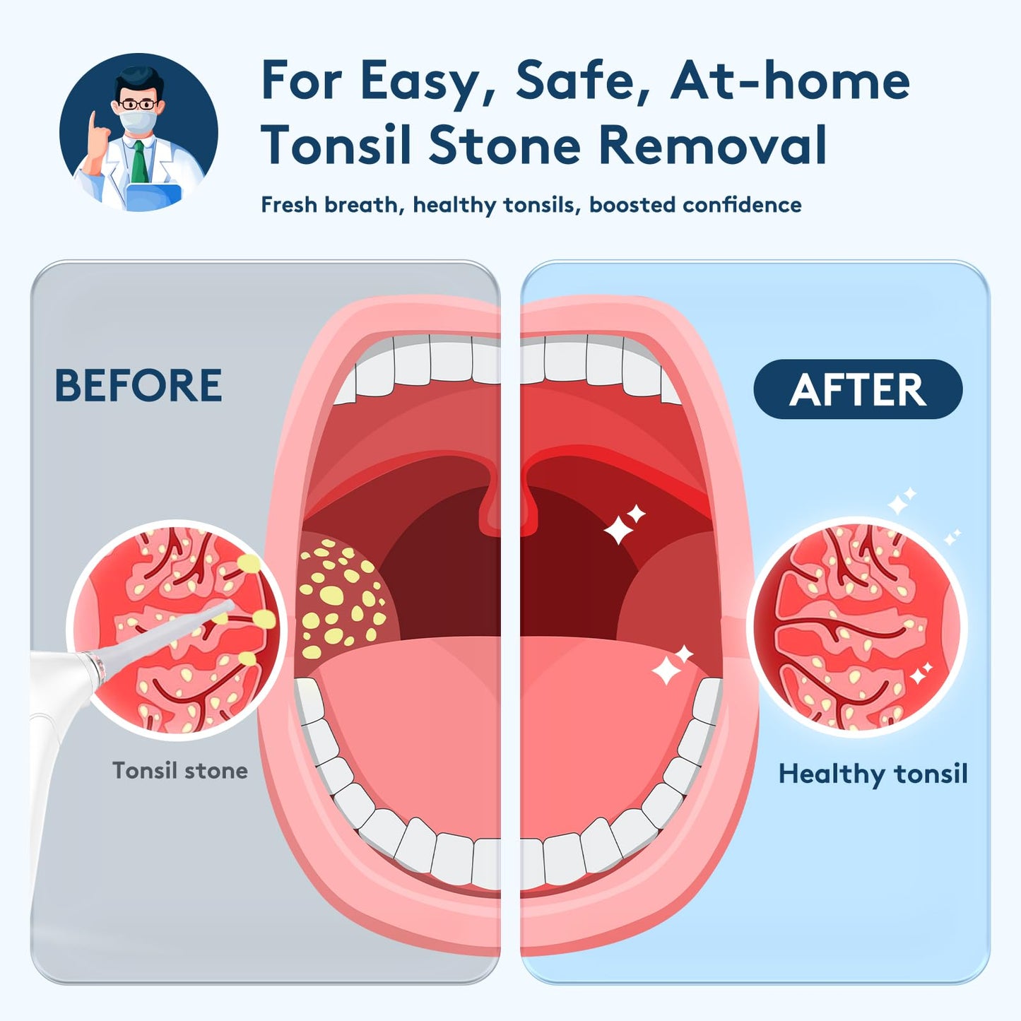 Tonsil Stone Remover Kit - Electronic Tonsil Stone Vacuum with Built-in LED Light - Tonsil Stone Removal Kit with 3 Levels Suction - Instant Suction - Irrigator and 5X Magnifying Mirror (White)