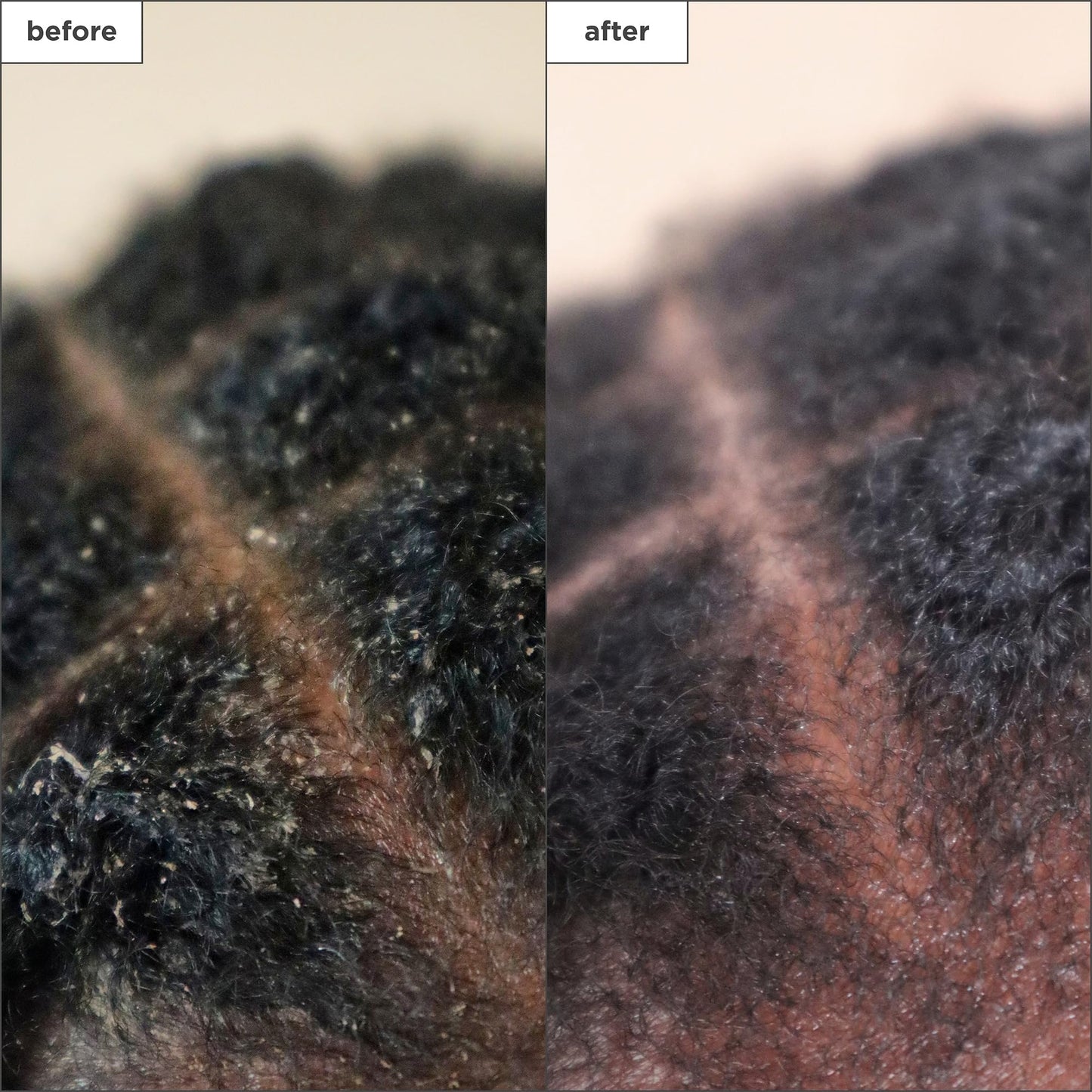Briogeo Scalp Revival Charcoal + Tea Tree Scalp Treatment, Scalp Serum to Soothe a Dry, Flaky, Itchy Scalp, Absorb Oil, Hydrate Dry Scalp, Clarify Build Up, Vegan, Cruelty-Free, 1 fl oz