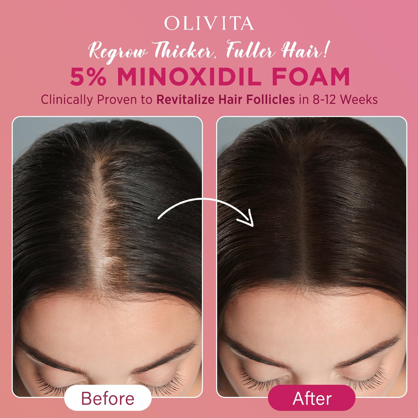 5% Minoxidil Foam for Women Hair Growth: Extra Strength Hair Regrowth Treatment – Revitalize Hair Follicles & Regrow Thicker, Fuller Hair – Hair Loss Solution-2pack