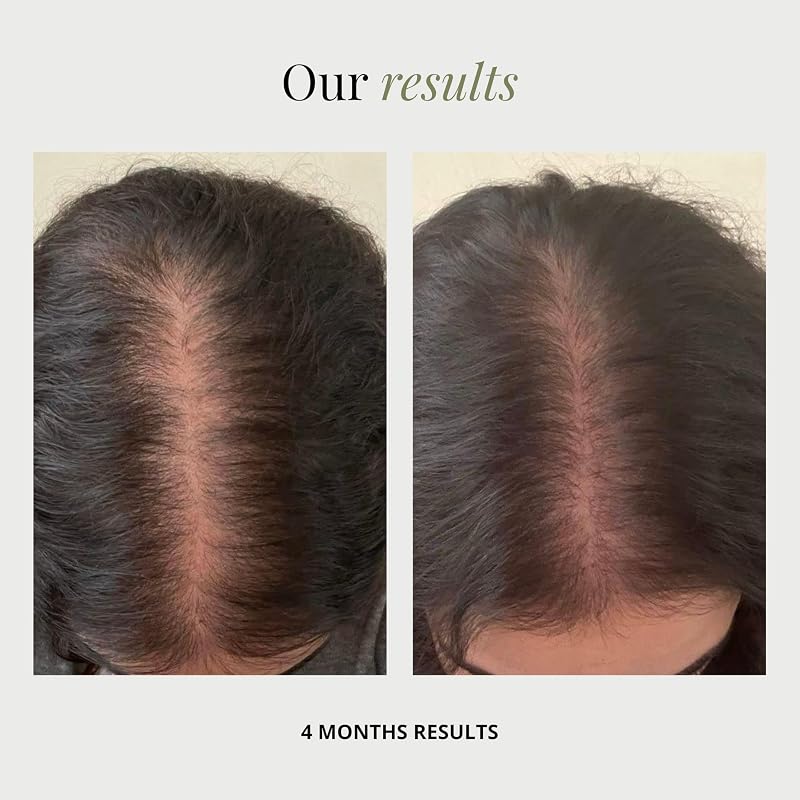 BUNDU Hair Growth Supplements – 90 Soft Capsules for Fuller Hair & Reduced Shedding