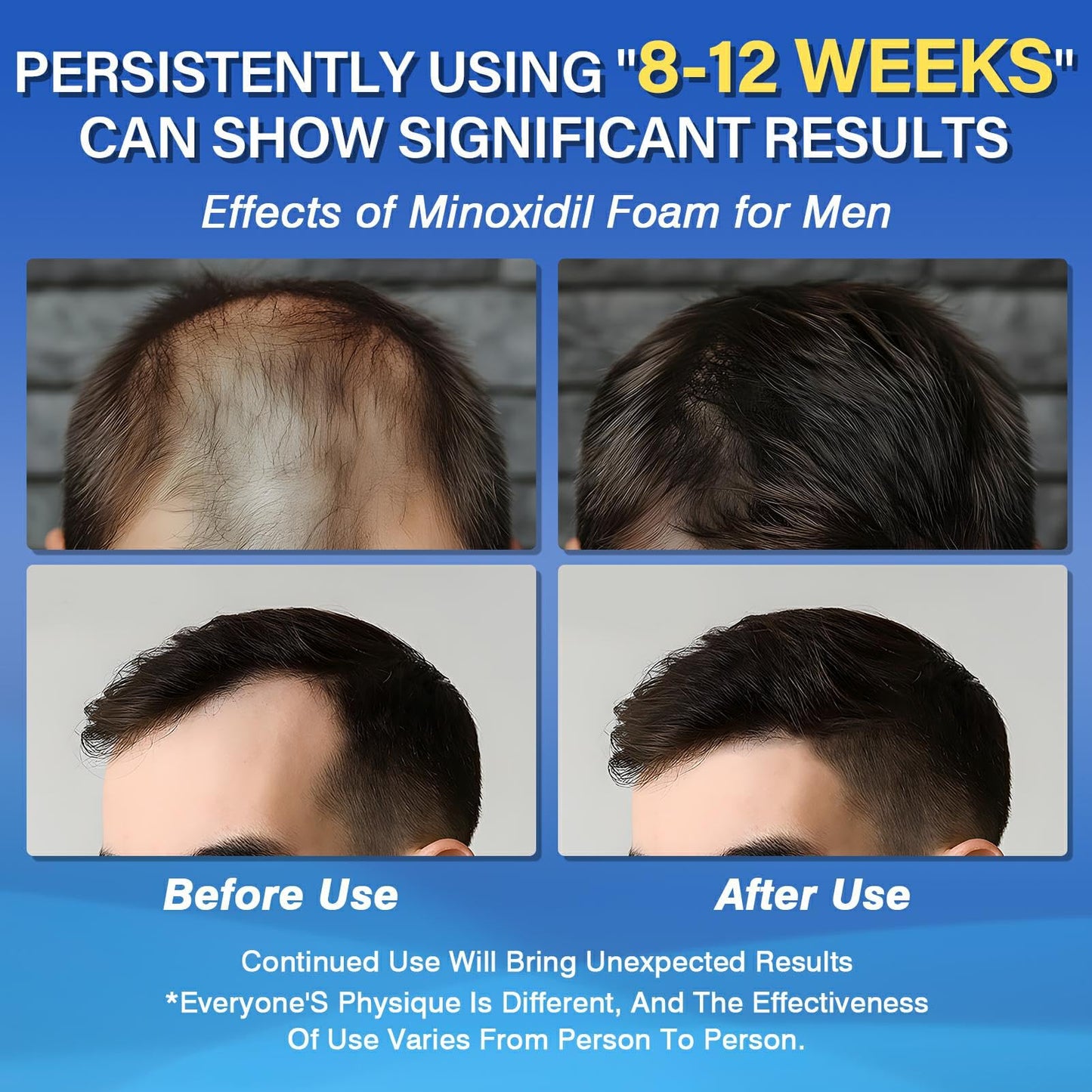 5% Minoxidil Foam for Men Hair Growth Foam Suitable for Hair Thinning Receding Hairline and Hair Loss to Hair Regrowth Get Thicker Fuller Hair 3 Bottles 2.11 Ounces Each