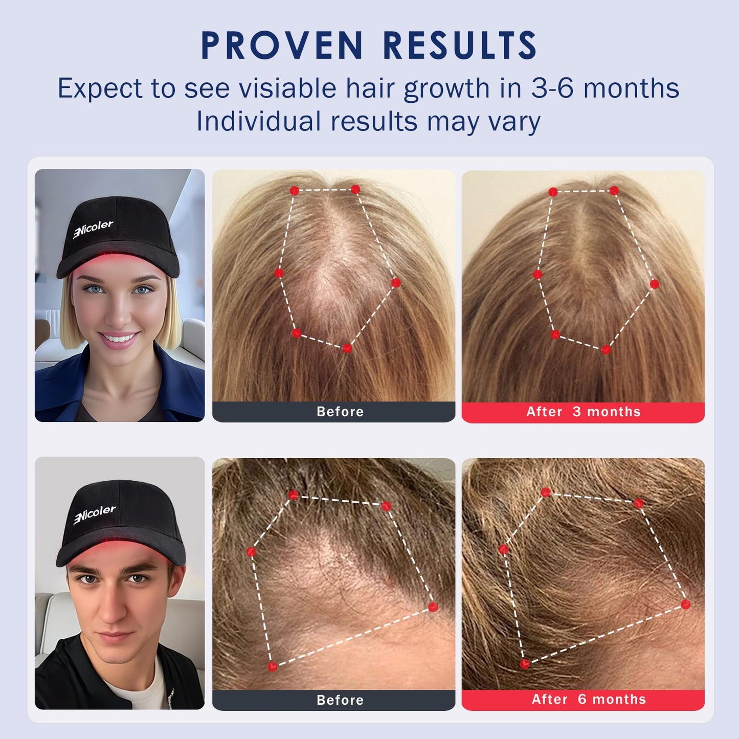 Nicoler Hair Growth Cap with 147 Beads, Laser Cap 650nm with Pulse Mode, Red Light Therapy for Hair Growth for Men & Women, Battery Pack, Black