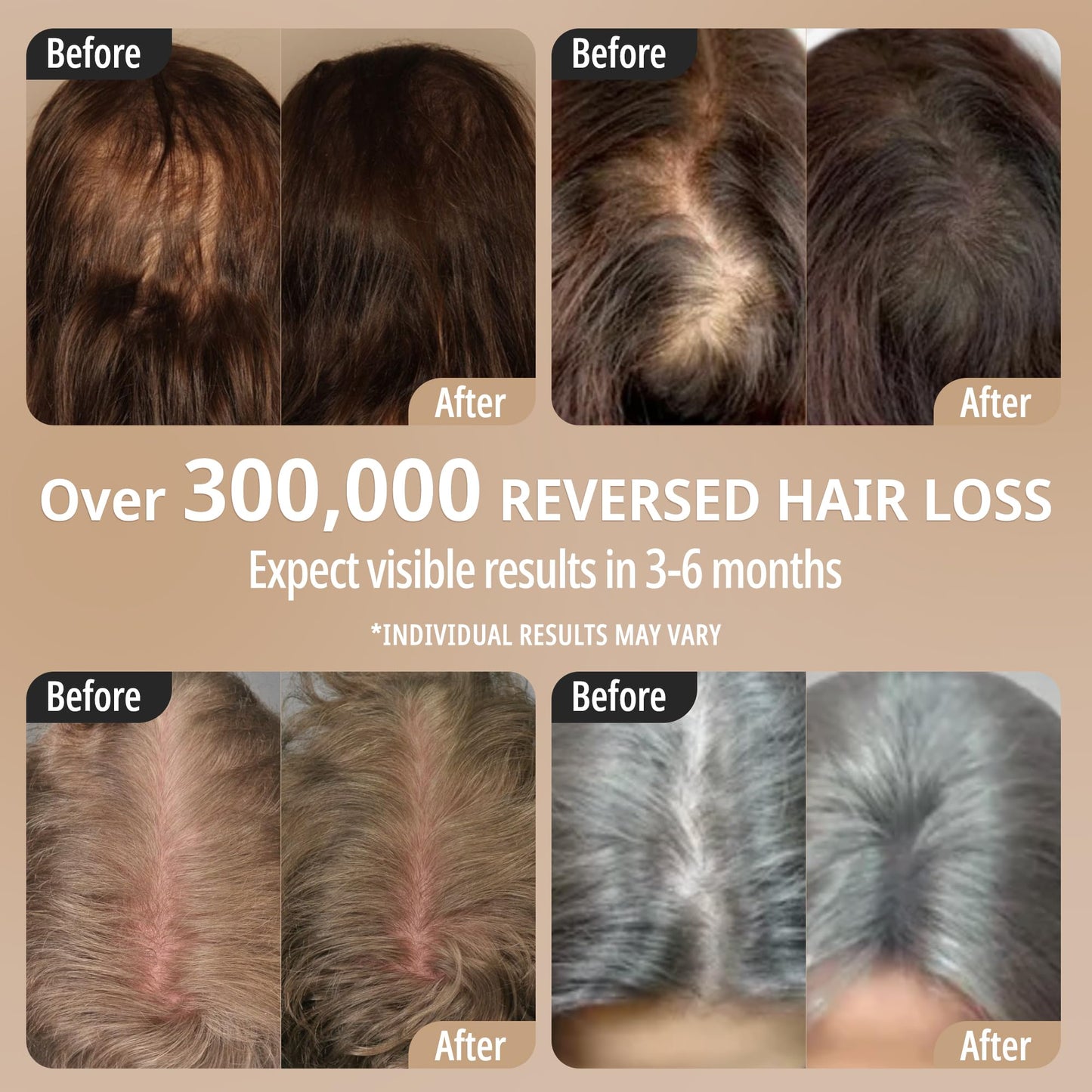 Breo Scalp 3L Laser Hair Growth Comb with 650nm Infrared Technology, 360° Scalp Massager, Waterproof Design, Effective Scalp Stimulation and Hair Regrowth