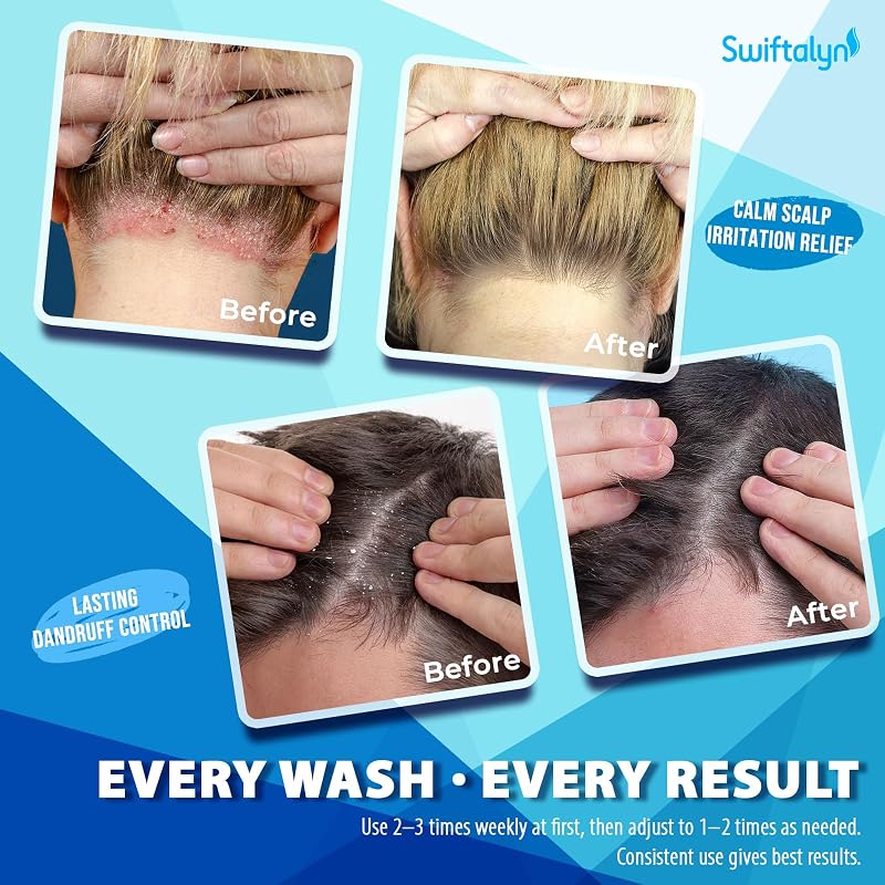 Herbal Fresh Antifungal Shampoo for Dandruff, Seborrheic Dermatitis & Folliculitis – Sulfate-Free Formula