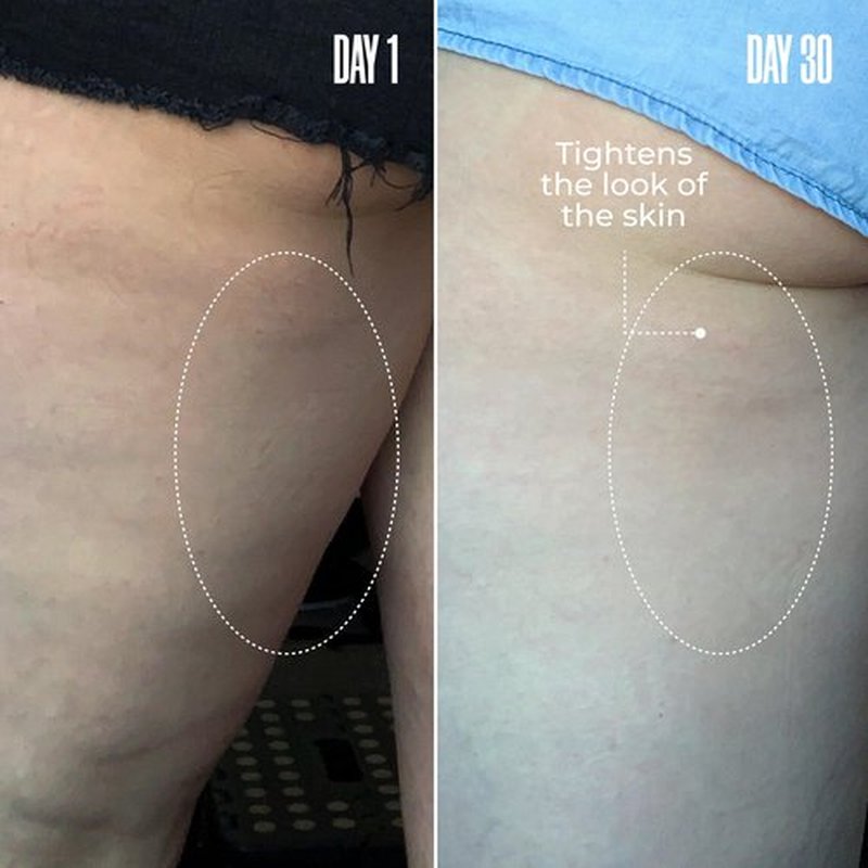 MAËLYS Cosmetics B-TIGHT Leave-On Cellulite Mask - Reduces The Appearance Of Cellulite - Visibly Tightens The Skin In The Butt Area