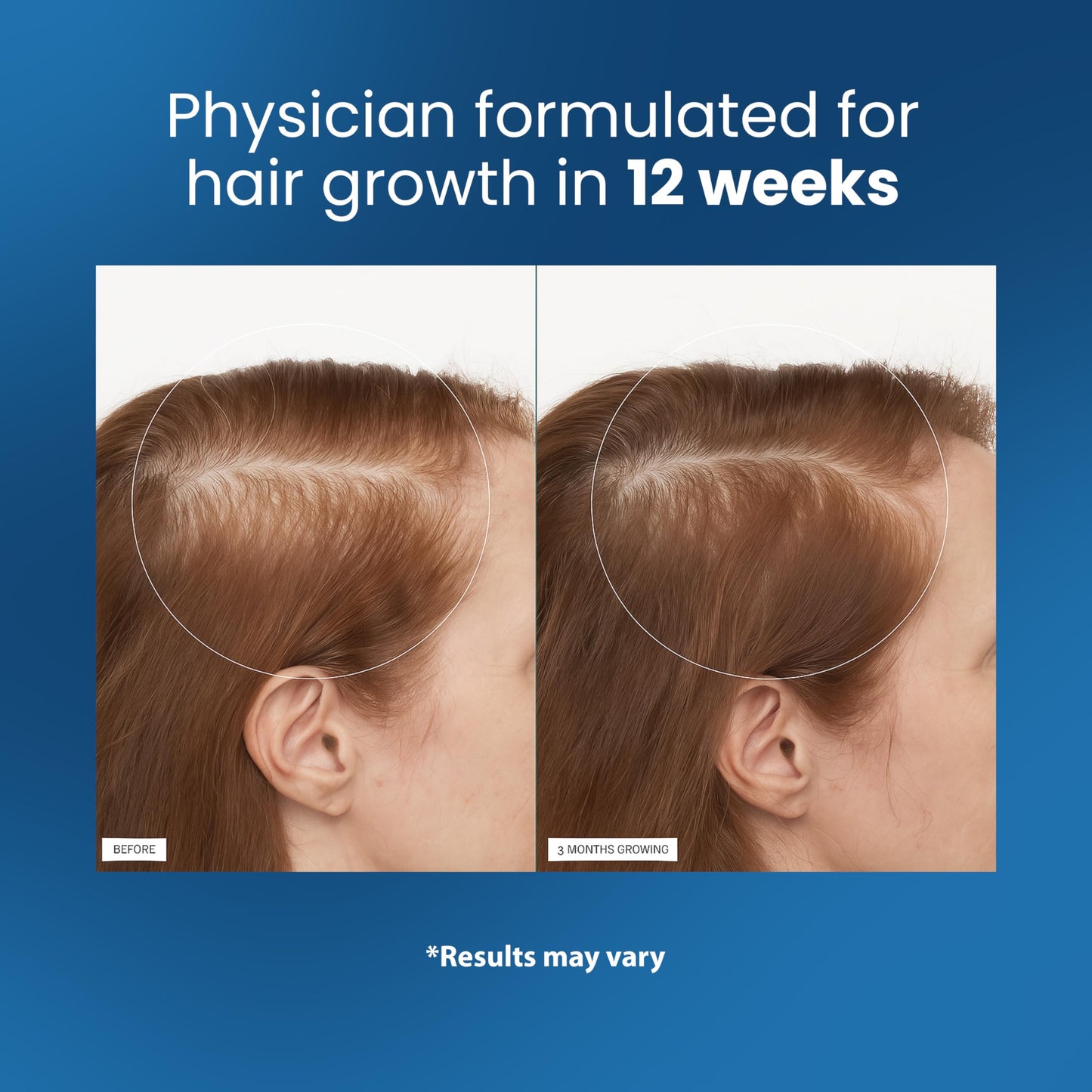 Be Bodywise Rosemary Hair Growth Serum Roll On 25 ml – 3% Rosemary, 3% Redensyl & 2% Anagain | DHT-Blocking Scalp Serum Boosts Oxygen Flow, Reduces Hair Fall | Paraben/Sulfate-Free | Women & Men