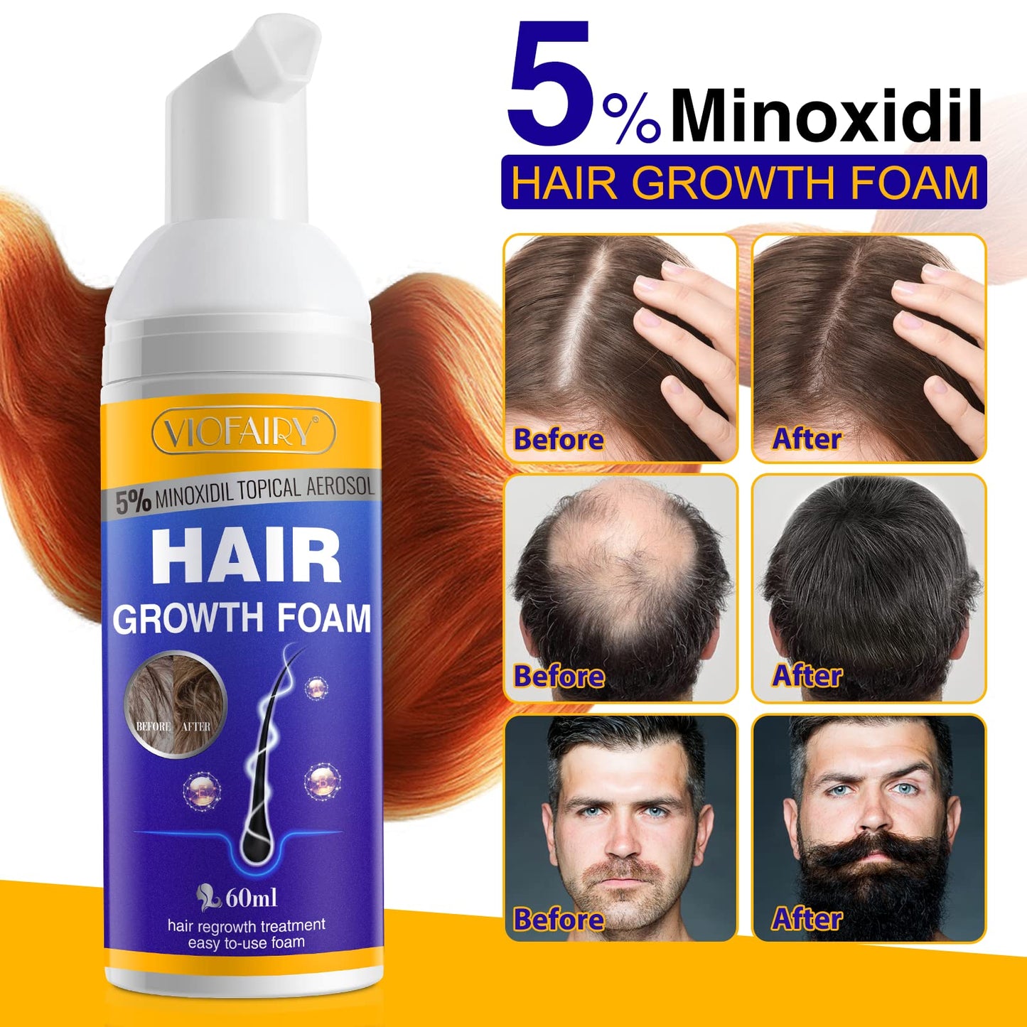 5% Minoxidil Foam for Hair Growth and Thickening - Biotin & Minoxidil Treatment to Stop Thinning & Hair Loss for Men & Women, 2oz