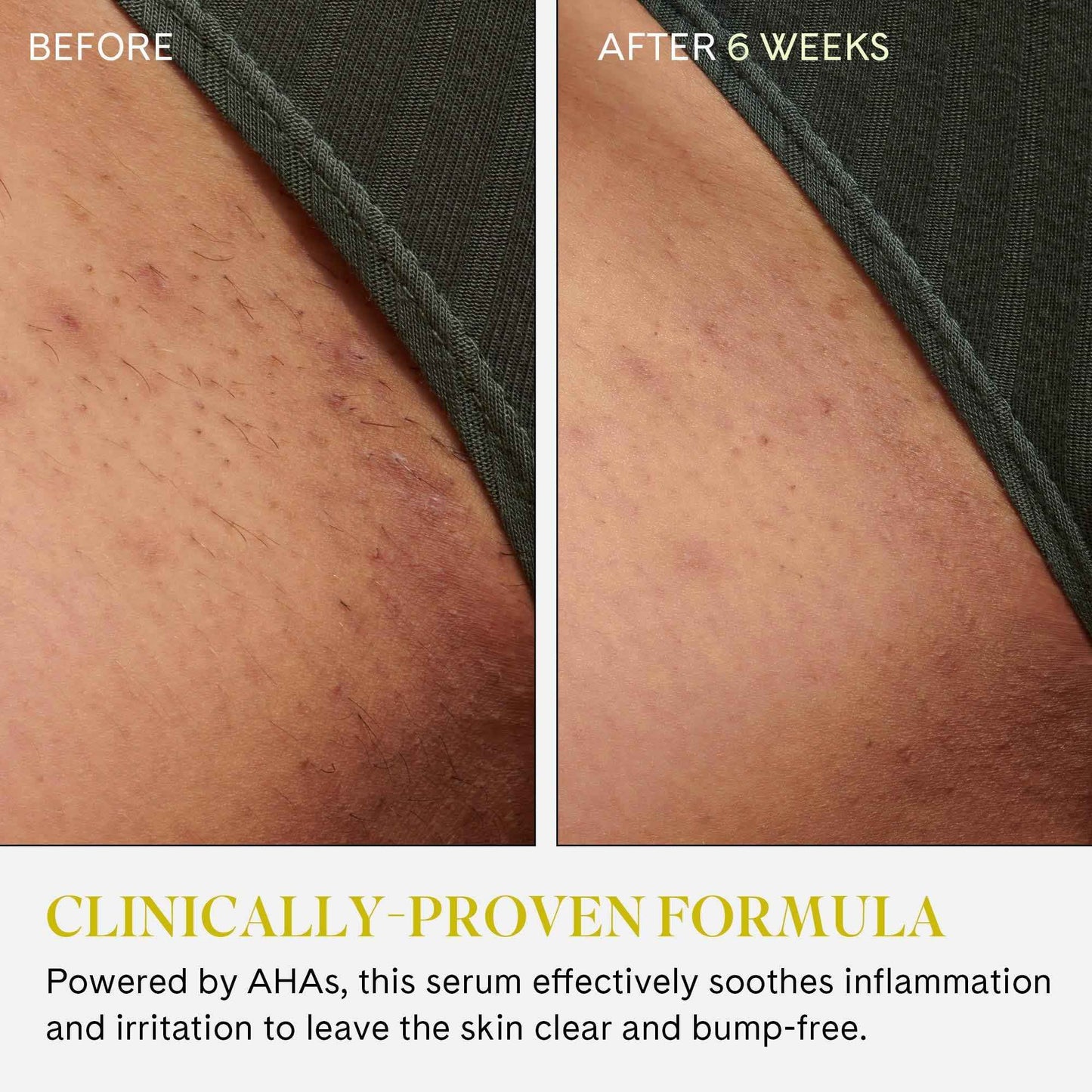 Fur Ingrown Eliminator Serum Rollerball Travel Size - Powerful Ingrown Hair Treatment Serum With AHAs and BHAs to Treat Ingrown Hairs and Bumps, Hydrates and Soothes Irritated Skin - 10 ml